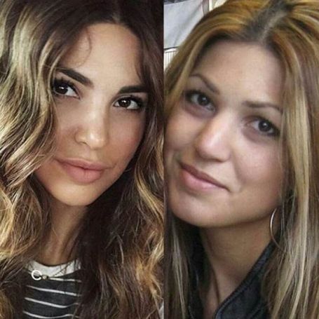 Negin Mirsalehi before and after plastic surgery